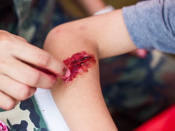 A healthcare professional is measuring a wound on a person's elbow.