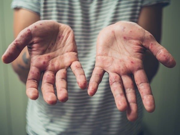 How to Perform an Enterovirus Test